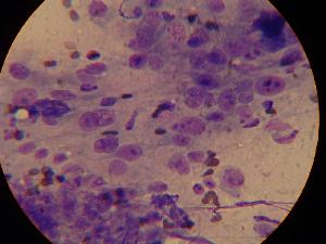 Microscopic view of a tumor