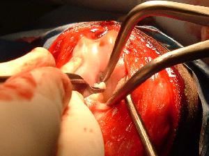 View of a dog's knee during surgery to repair an ACL View of a dog's knee during surgery to repair an ACL